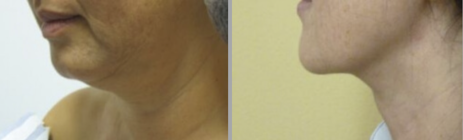 Neck Lift in Ventura, CA